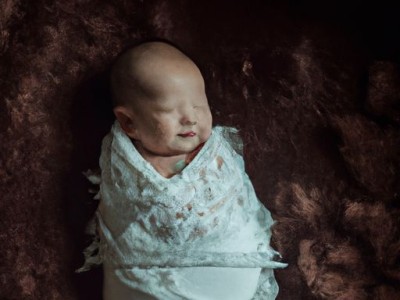 婴儿被蚊子咬了怎么消肿止痒最快